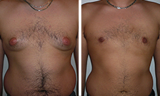 Chirurgie-gynecomastie-tunisie-avant-apres